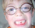 Brock Tooth