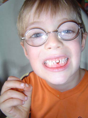 Lost Tooth Brock