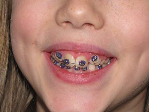 Maddy Braces 01